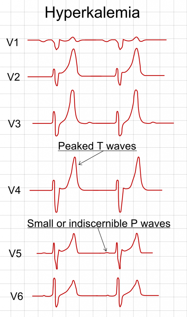 ECG_in_hyperkalemia