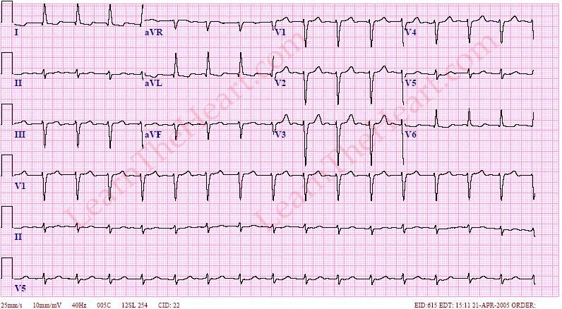 Akselere Junctional Ritim