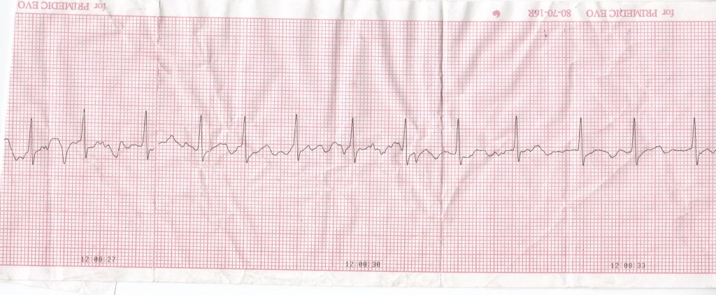 EKG1