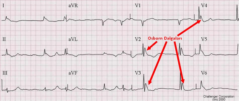 HypothermiaECG
