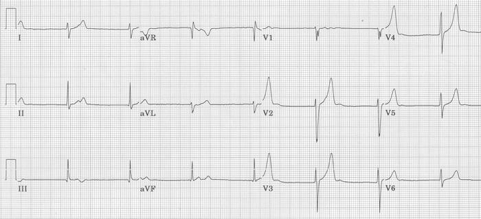 Junctional Rhythm