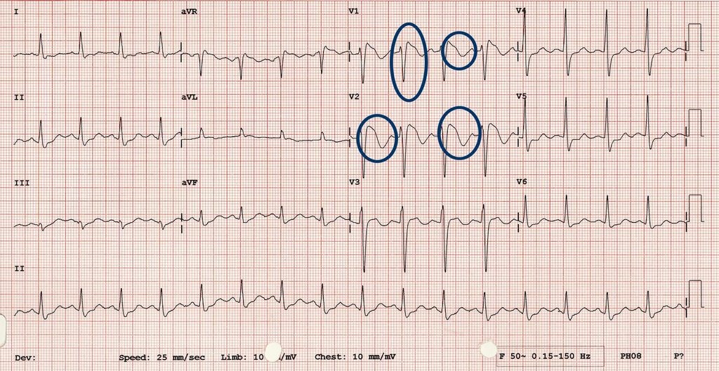 Tip 1 Brugada EKG Örneği-3