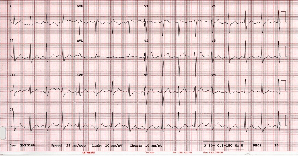 Brugada-type-2-1024x536