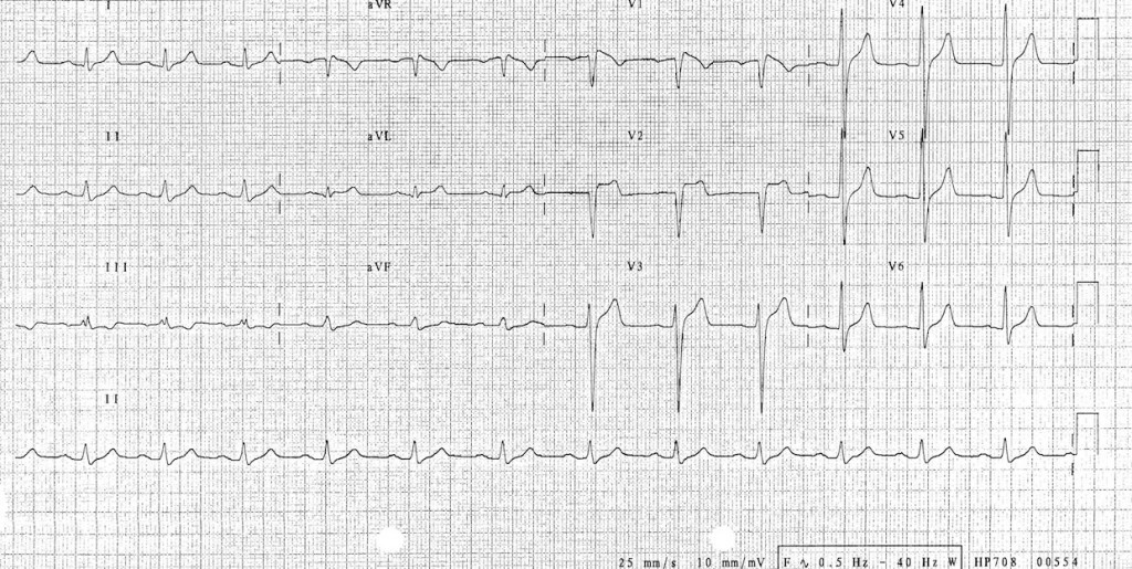 Brugada tip 3