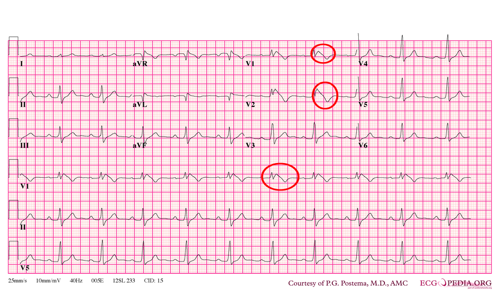 Tip 1 Brugada EKG Örneği - 2