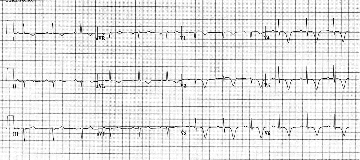 Wellens Sendromu | Resüsitasyon